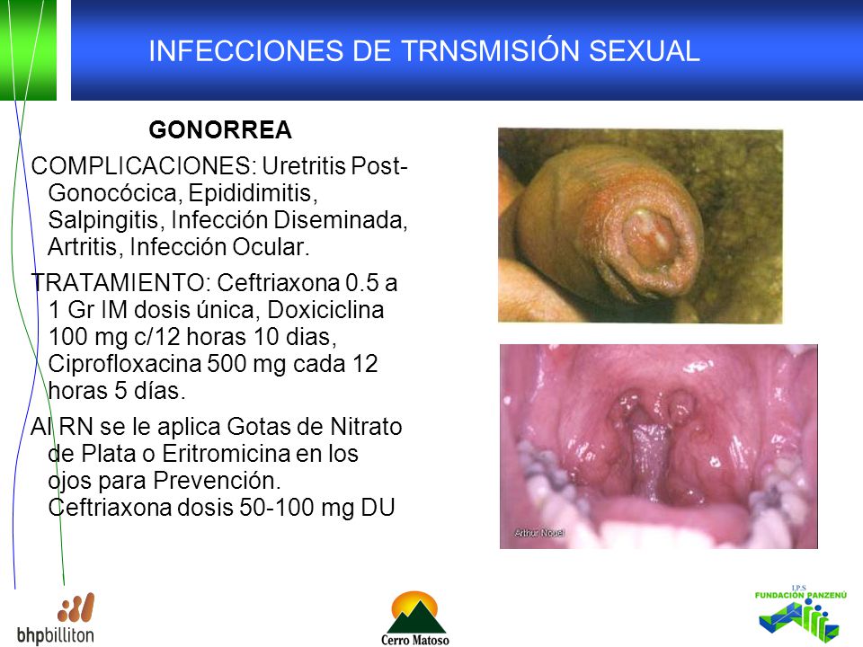 infección por gonococcla diseminada piel